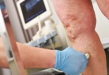 Sarcoma de tejido blando: el cáncer silencioso que puede confundirse con una lesión común y retrasar su diagnóstico