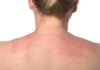 Hoy se conmemora el Día Mundial de la Dermatitis Atópica