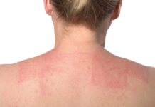 Hoy se conmemora el Día Mundial de la Dermatitis Atópica