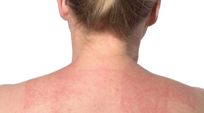 Hoy se conmemora el Día Mundial de la Dermatitis Atópica